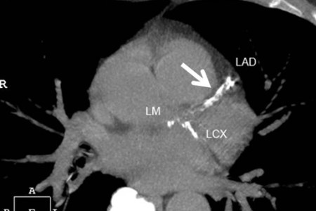 Calcium Heart Scan, detects early death