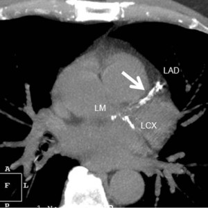 Calcium Heart Scan, detects early death