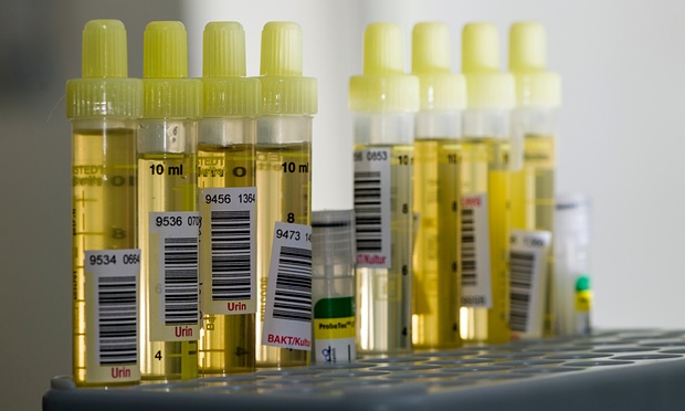 Urine test detects early-stage pancreatic cancer